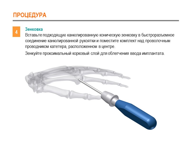 ПРОЦЕДУРА 4 Зенковка Вставьте подходящую канюлированную коническую зенковку в быстроразъемное соединение канюлированной рукоятки и